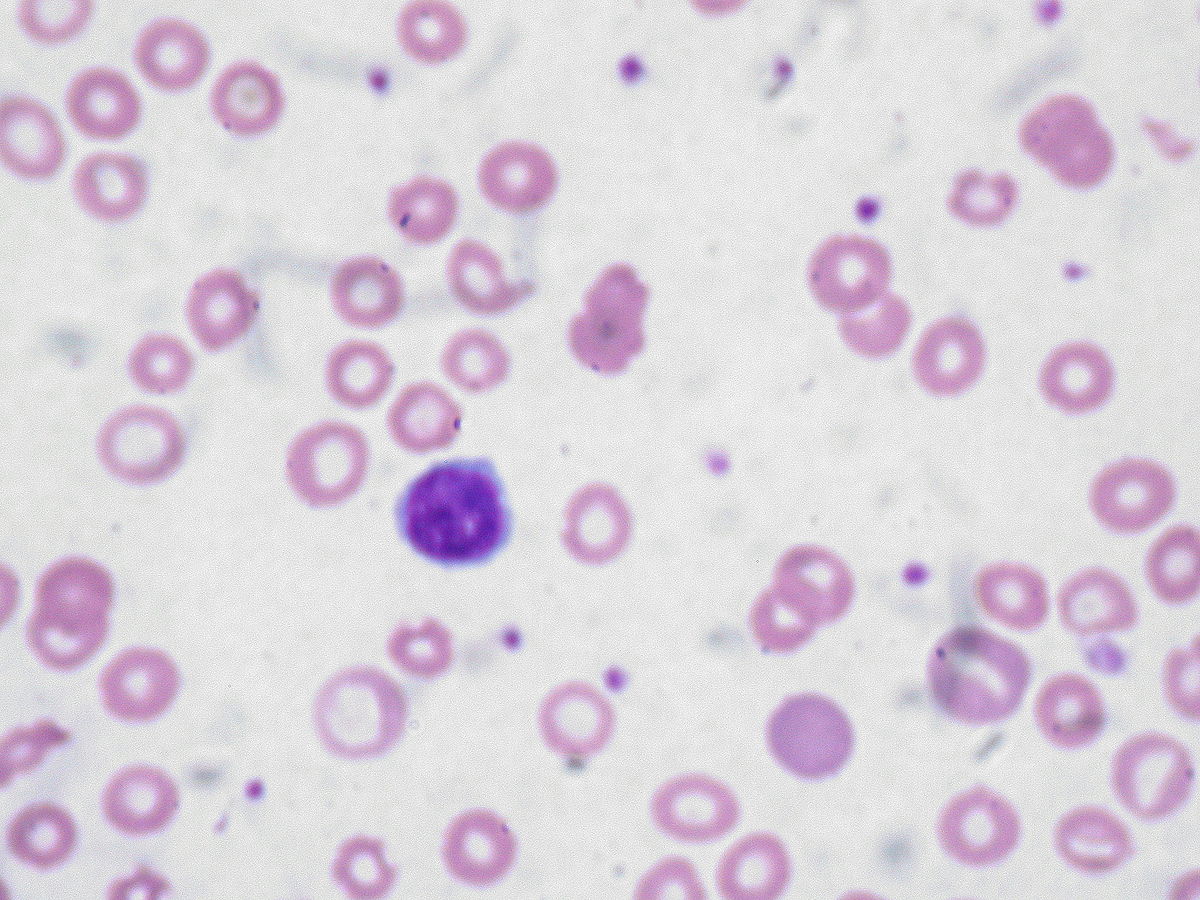 Analyse du sang : L&rsquo;anisocytose : diagnostic et traitements